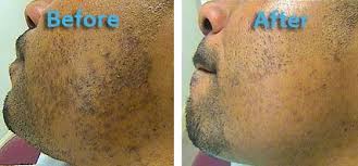 Unlike some other hair removal methods, laser hair removal does not just allow you to shave in between treatments—it's actually a requirement. Skin Care With Pfb Vanish Face Fitness Ltd