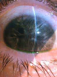 If someone with 20/20 vision was standing next to a person who's legally blind, in order for the legally blind person to see an object that's 200 feet away as well as the person with the normal vision they would have to get as close as 20 feet to it. Can You Go Blind From Lasik