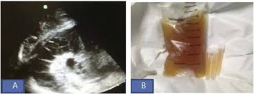 In addition, a diagnostic and therapeutic thoracentesis of a l > r pleural effusion was performed. A Ultrasound Image Showing Loculated Pleural Effusion Fig 2b Yellow Download Scientific Diagram