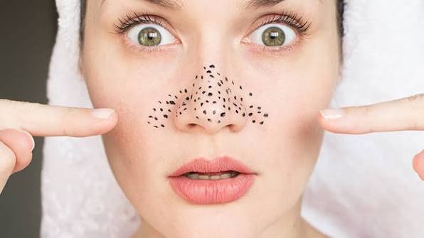 komedo di hidung