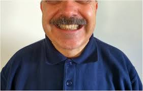 Hyperacute relapse of Lewis-Sumner syndrome during influenza A (H1N1) virus  infection