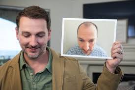 A bosley hair transplant restoration is a permanent solution. Bosley Hair Transplant Restoration 95 Photos 68 Reviews Hair Loss Centers 9100 Wilshire Blvd Beverly Hills Ca United States Phone Number Yelp