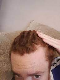 Do You Think This Is Receeding Hairline Or Just My Hairline As U Can See I Have Dreads And Right Now They Ha Receeding Hairline Hairline Celebrity Hair Colors
