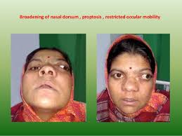 The nasal cavity and paranasal sinuses contain several types of tissue, and each contains several types of cells. Tumours Of Nasal Cavity Paranasal Sinuses