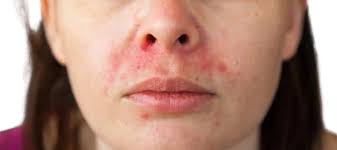 Image result for contact dermatitis