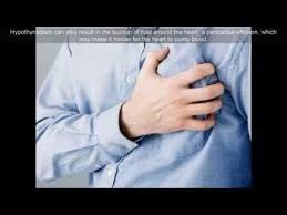 Complications Of Hypothyroidism What Are The Consequences Of Untreated Hypothy Heart Attack Causes Of Heart Attack Centers For Disease Control And Prevention