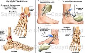 Resultado de imagem para fraturas radiologia