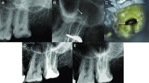 Maybe you would like to learn more about one of these? This Case Was Referred To One Of The Authors Aaa For Root Canal Download Scientific Diagram