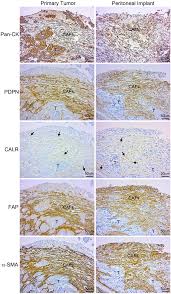 Image result for Primary Tumor Localization