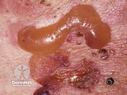 Image result for Pemphigoid