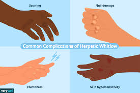 Hello, for such cracking skin on hands, apply lots of moisturing lotion and vit e on the hands. What Is Herpetic Whitlow