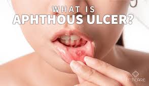 Image result for mouth ulcer on tongue)