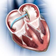 Set it so its all metal mode does not sound off when a local hot rock is waved directly in front of the coil. Heart Defect Asd Occlutech Perfecting Performance