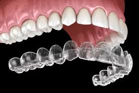 Invisalign® is a Popular Option for Teeth Straightening - Smiles Dental  Care Mountain View California