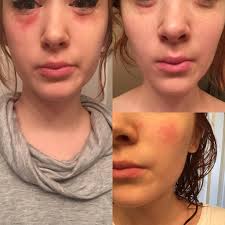 If you spot these red dots