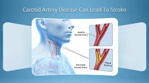 Both the right and left common carotid arteries divide into the external and internal carotid arteries at the carotid bifurcation. Carotid Artery Disease Can Lead To Stroke If Left Untreated