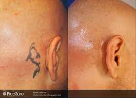 With over 17 years of experience removing tattoos from thousands of people, we can help. Laser Tattoo Removal Sydney Picosure Tattoo Removal Treatment