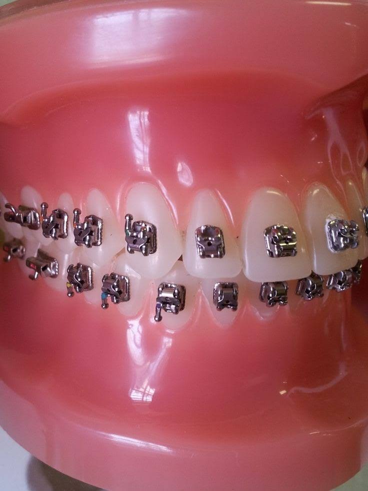 Self Ligating Braces product image