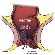 How do healthcare providers treat hemorrhoids? - MEDizzy