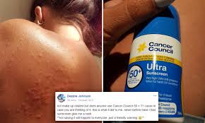 Reviews, 'shelfies', sales and discussions. Woman Left With Rash After Using Cancer Council Sunscreen Daily Mail Online
