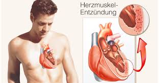 Sie entsteht oft infolge eines verschleppten, grippalen infekts. Mooci Herzmuskelentzundung So Wirst Du Sie Los