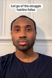 Black Man Receding Hairline Needs to Let It