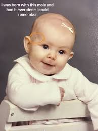 My Birth Mark Turned into Melanoma