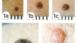 Use the menu to see other pages.staging is a way of describing where the cancer is located, if or where it has spread, and whethe. Non Melanoma Skin Cancers Skin Cancer Youtube