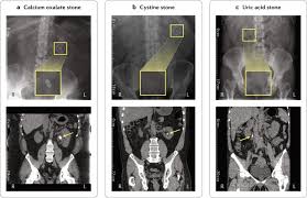 Image result for Calcium Nephrolithiasis