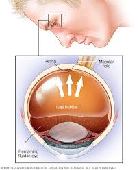 Your natural eye fluid may seep through that hole and build up behind the retina. Retinal Detachment Diagnosis And Treatment Mayo Clinic