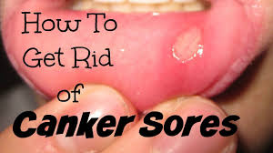 How To Get Rid Of Canker Sores Canker Sore Cankers Cancer Sore