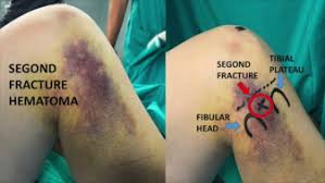 Image result for Segond Fracture