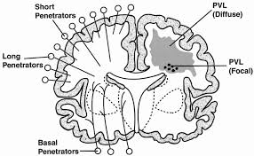 May 4, 2020 to june 30, 2020. Neurobiology Of Periventricular Leukomalacia In The Premature Infant Pediatric Research