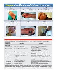 Image result for Wagner Ulcer Classification