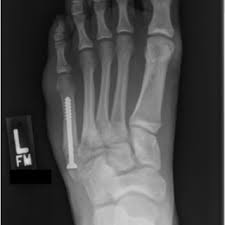 Learn about the jones fracture, what types of treatments are available, and if jones fracture surgery is the best treatment option. A Charlotte Carolina Screw Transfixes A Healing Fracture Of The Download Scientific Diagram