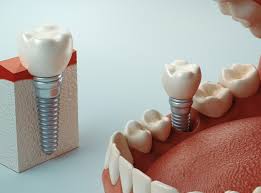 How much does insurance pay for dental implants? Are Dental Implants Covered By Health Insurance Healthtimes