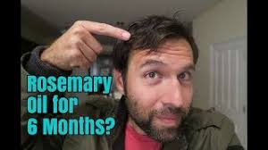 Rosemary oil can go off quite quickly. Rosemary Oil For My Hair Loss Photos Before And After 6 Month Experiment Youtube