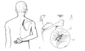 Image result for Scapulothoracic Injection