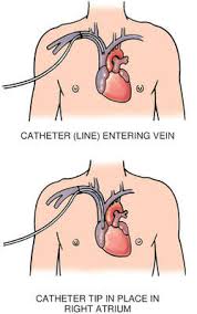 The abbreviation for urinalysis is. Catherter Definition Of Catherter By Medical Dictionary