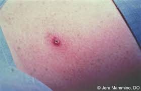 Symptom stages can occur in any order and some side effects include heavy pain on the affected extremity, cramping, and labored breathing. Spider Bites American Osteopathic College Of Dermatology Aocd