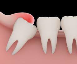 Image result for Tooth Extraction