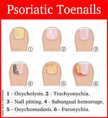 Image result for Pitting nails feet