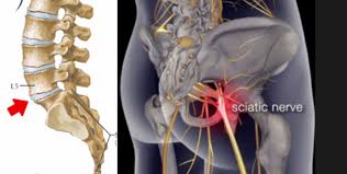 Pin On Degenerative Disc Disease