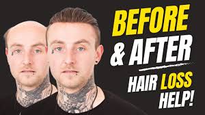 How to Apply (Attach) a Non-Surgical Hair Replacement System for Men with  The Harris Brothers UK