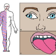 Clinical Manifestations Of Medial Medullary Syndrome A Body Download Scientific Diagram