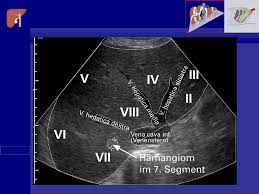 lebersegmente sono medical ultrasound diagnostic medical sonography ultrasound sonography