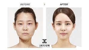 Nose Surgery In Korea Rhinoplasty Revision In South Korea Korea Nose Surgery Korea Nose Revision Korea Nose Job Korea A Nose Surgery Diy Skin Cream Rhinoplasty