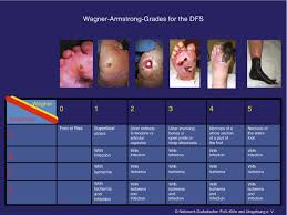 Image result for IDSA Diabetic Foot Wound Classification