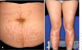 Image result for pruritic urticarial papules and plaques of pregnancy