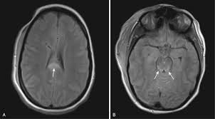 Image result for Brain Contusion